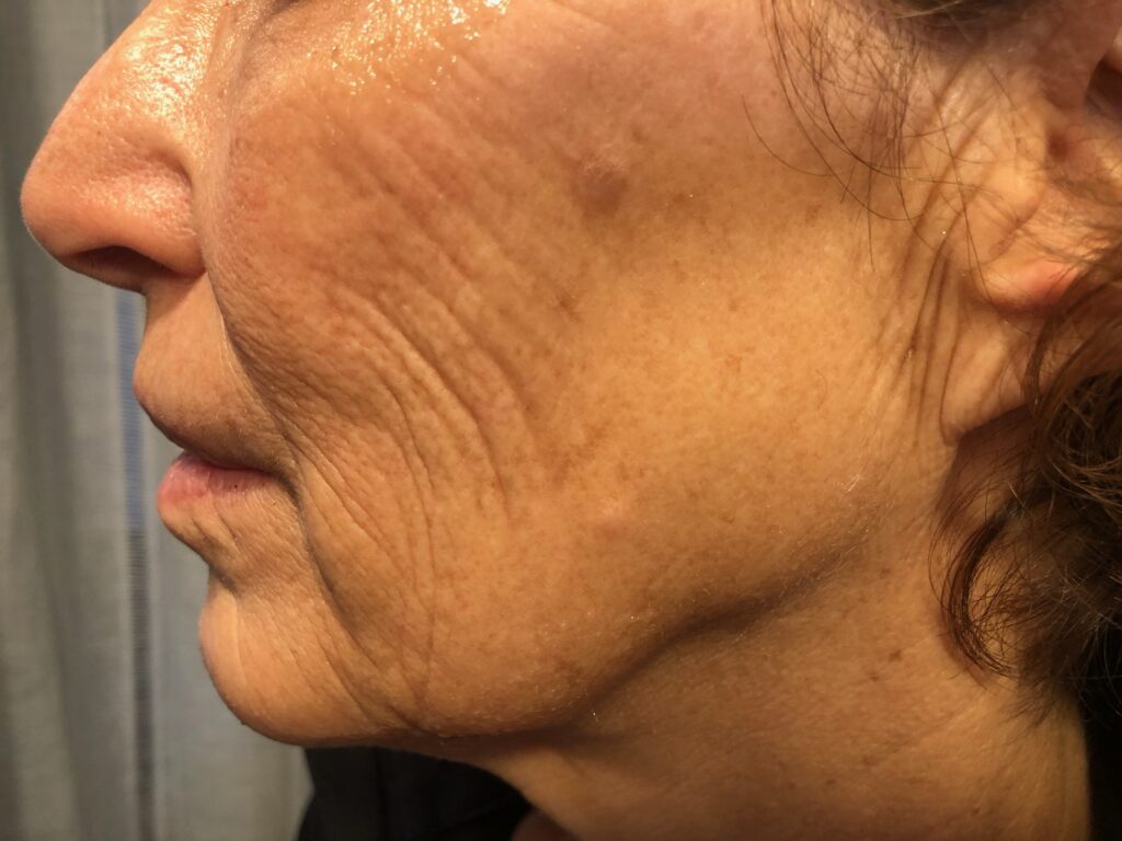 Before treatment photo showing facial wrinkles and skin texture at Dr. Anita Medical Aesthetics