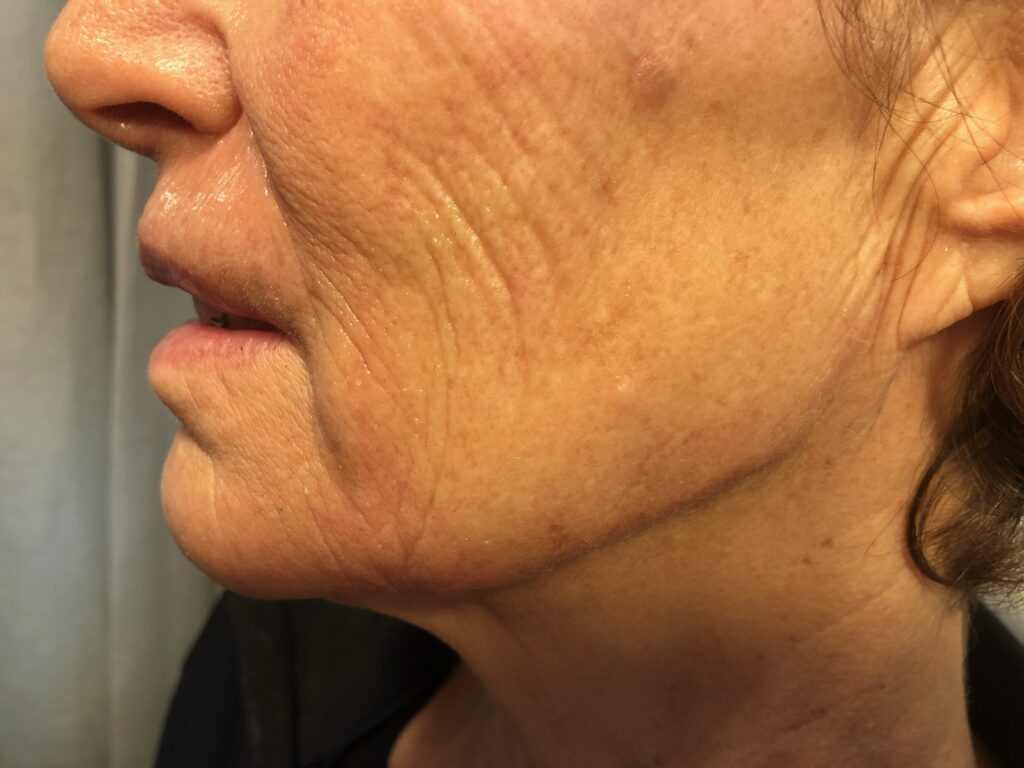 After treatment photo showing smoother, rejuvenated skin at Dr. Anita Medical Aesthetics