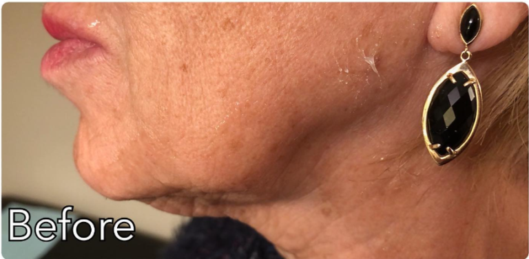 Before lip filler treatment photo at Dr. Anita Medical Aesthetics