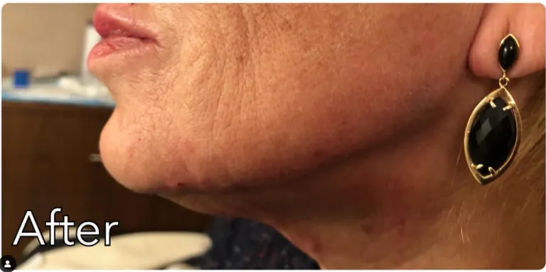 After lip filler treatment photo at Dr. Anita Medical Aesthetics
