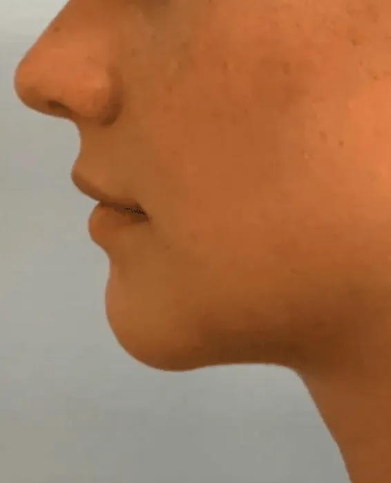 After treatment photo of patient's chin profile at Dr. Anita Medical Aesthetics