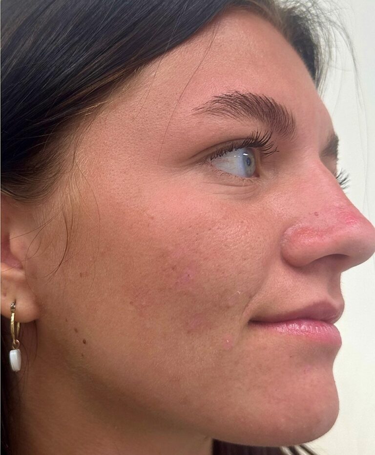 After acne treatment photo showing clear skin at Dr. Anita Medical Aesthetics