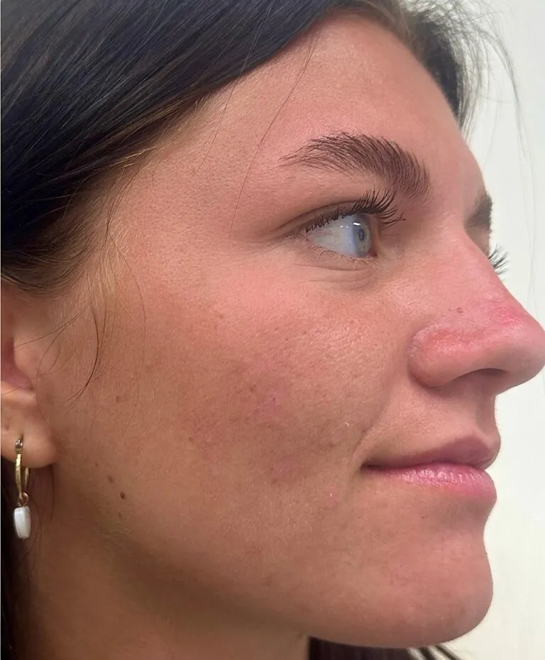 After acne treatment photo showing clear skin at Dr. Anita Medical Aesthetics