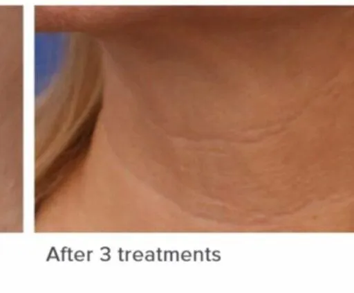 After skin rejuvenation treatment photo at Dr. Anita Medical Aesthetics