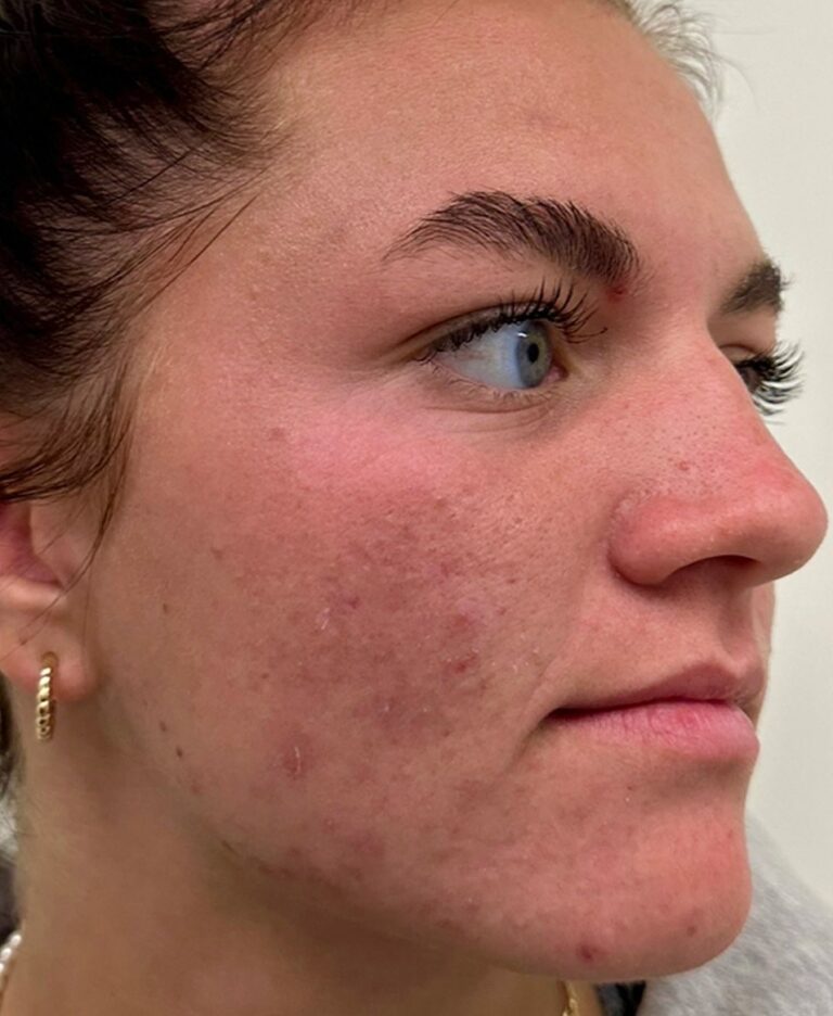 Before acne treatment photo at Dr. Anita Medical Aesthetics