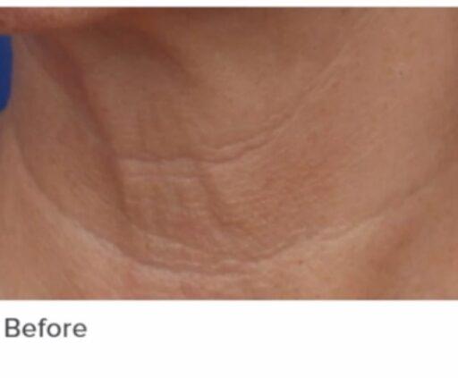 Before skin rejuvenation treatment photo at Dr. Anita Medical Aesthetics