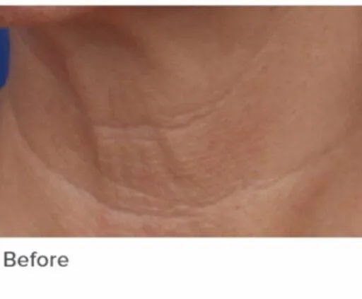 Before skin rejuvenation treatment photo at Dr. Anita Medical Aesthetics