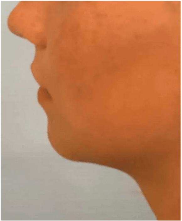 Before treatment photo of patient's chin profile at Dr. Anita Medical Aesthetics