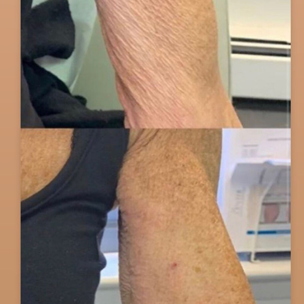 biostimulation